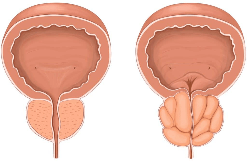 Kas atsitinka su prostata prostatito metu