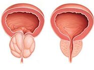 Prostatitas